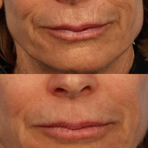 Collagen Volume Balm