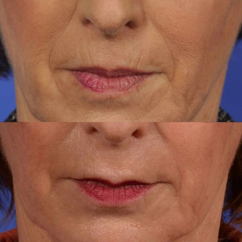 Collagen Volume Balm